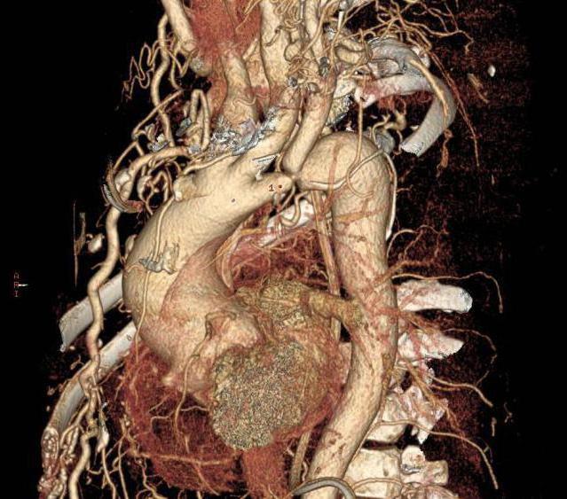 coarctation of the aorta ICD