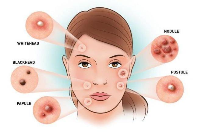 el acné Hormonal