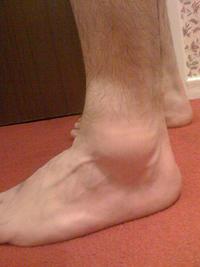 swelling of ankles