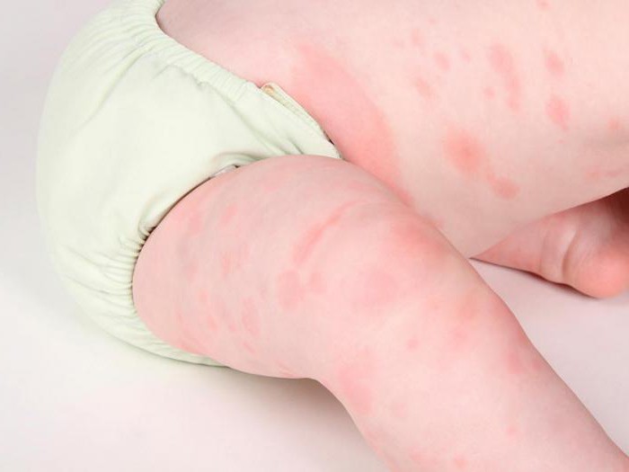 Алергія на глютен у дитини симптоми фото