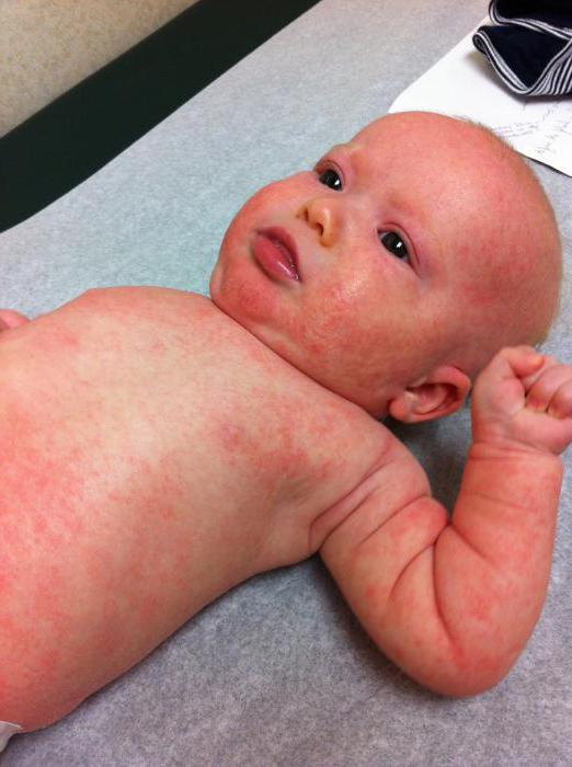 Аллергия глютен белгілері және емшектегі балаларда
