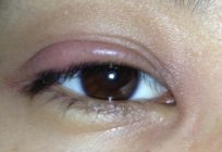 为什么肿的眼睑上的眼睛做什么，在这种情况下？