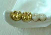 皇冠的金属铸：照片，以审查，安装。 制造金属冠上的牙齿