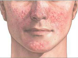 चेहरे पर pimples के लिए जो शरीर के इलाज के लिए कैसे