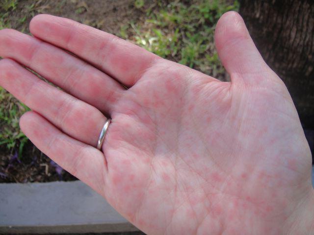 rash on the palms and soles of the child and the adult