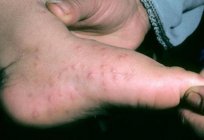 皮疹在棕榈树和脚的儿童和成人：原因和治疗